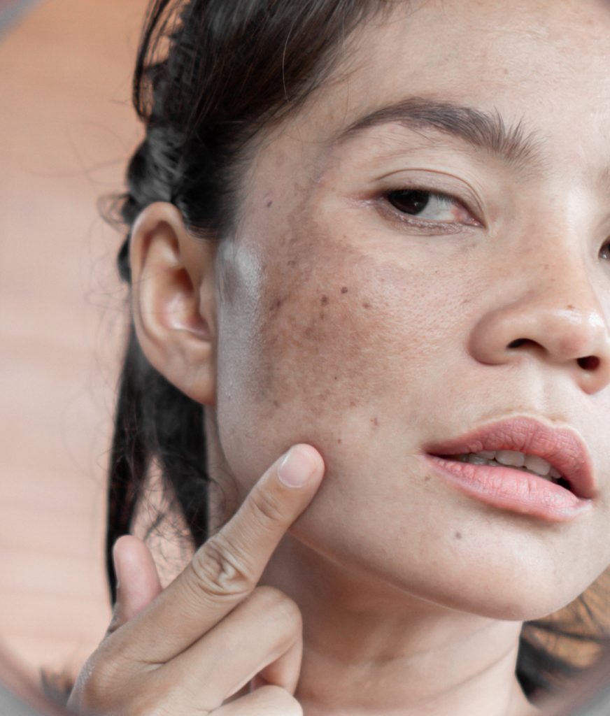 How to Spot Signs of Sun Damage